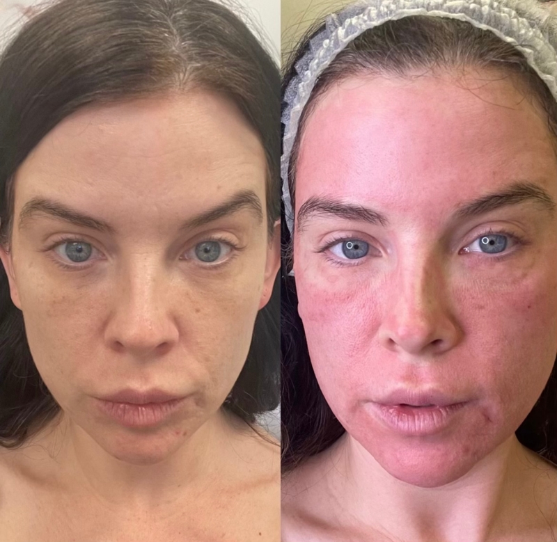 Before after Microneedling