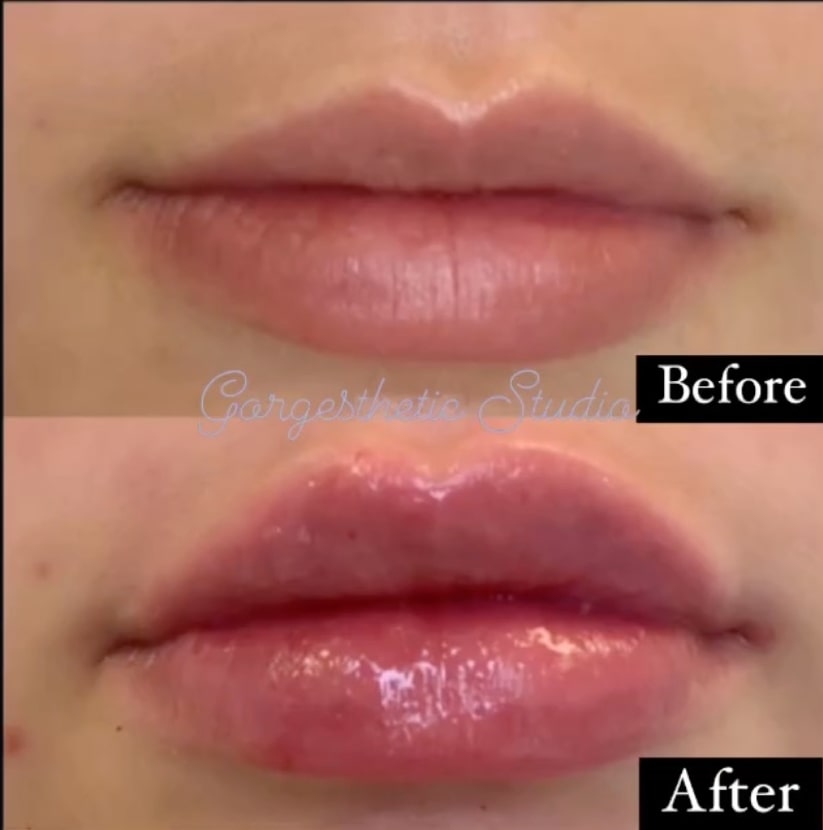 BOTOX® before and after results